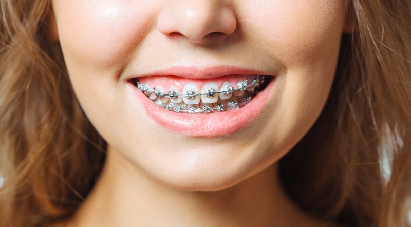 Dental Braces